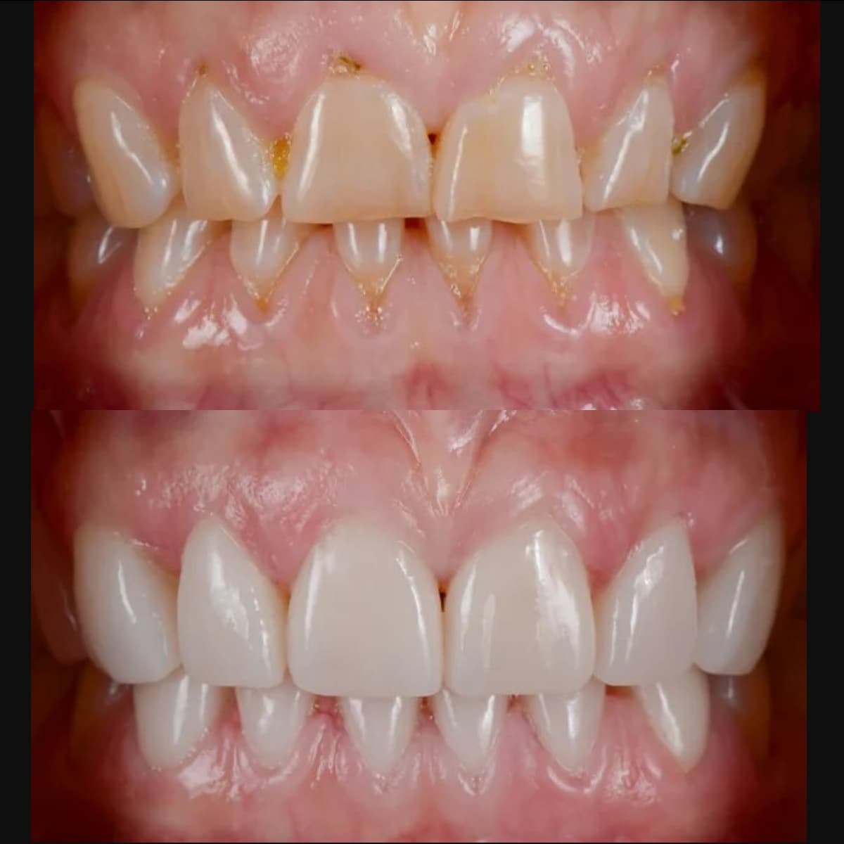Dental Crowns