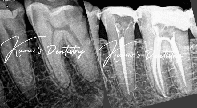 Root Canal Treatment under microscope