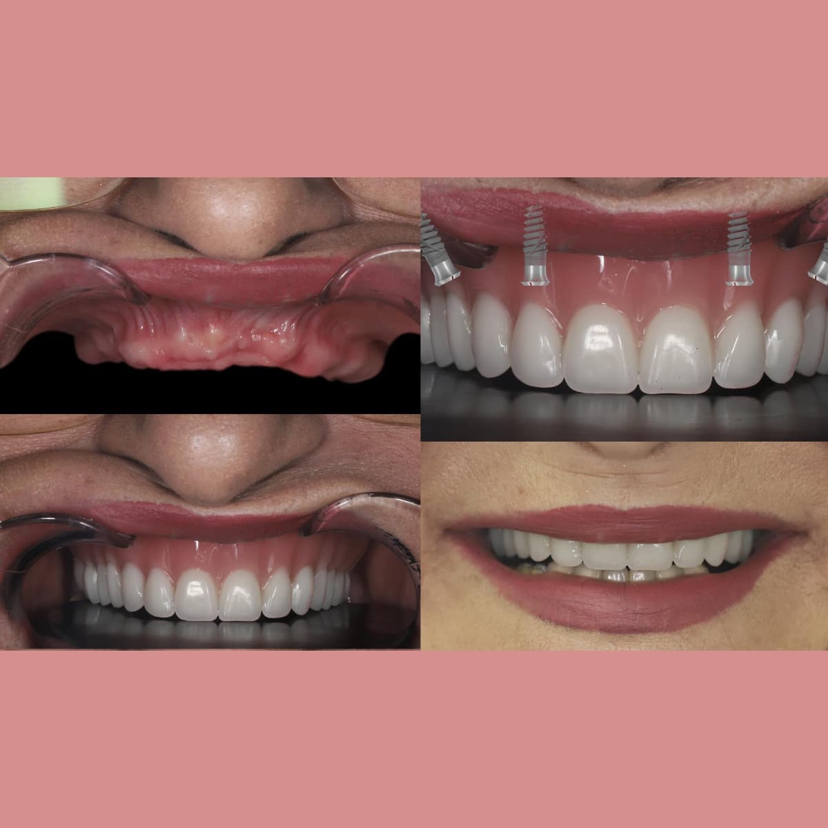 Dental Implants