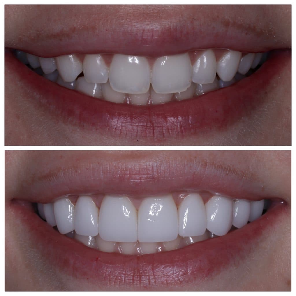 Smile Design