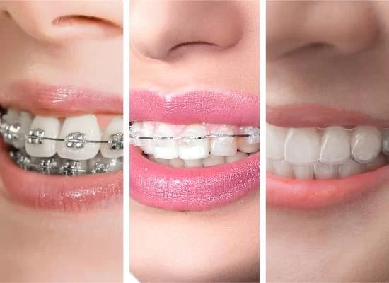 Invisible Aligners