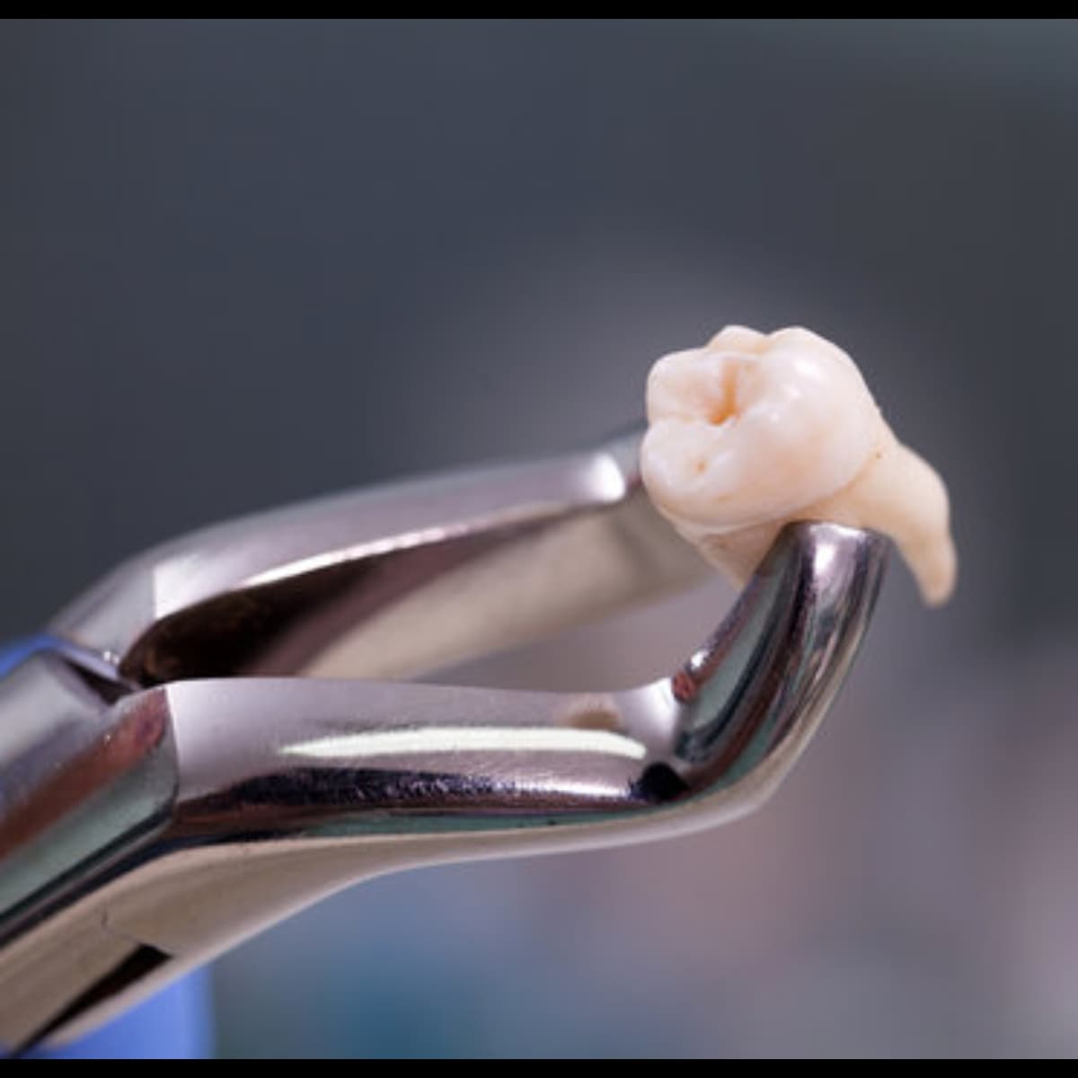 Wisdom Tooth Removal
