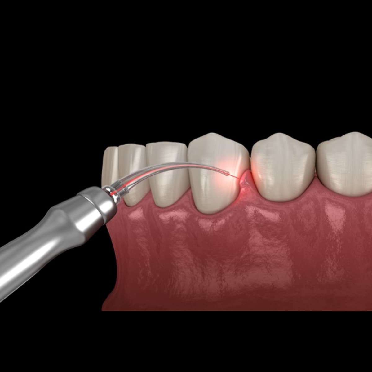 Laser Dentistry